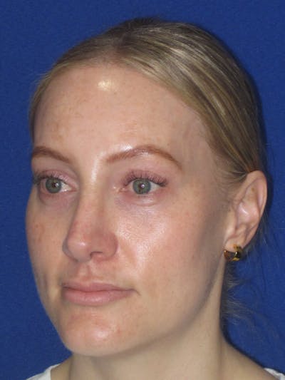 Rhinoplasty Before & After Gallery - Patient 228460 - Image 6