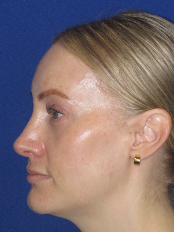 Rhinoplasty Before & After Gallery - Patient 228460 - Image 10