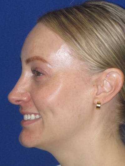 Rhinoplasty Before & After Gallery - Patient 228460 - Image 8