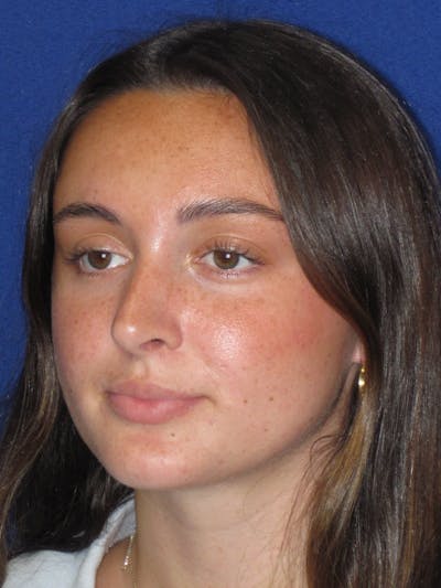 Rhinoplasty Before & After Gallery - Patient 283039 - Image 8