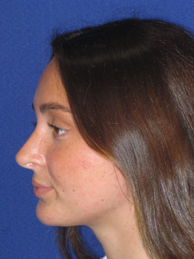 Rhinoplasty Before & After Gallery - Patient 283039 - Image 10