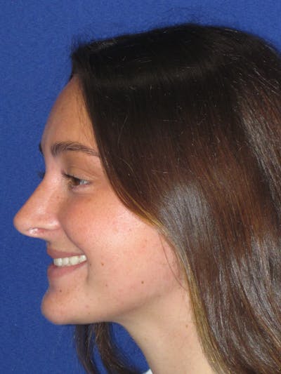 Rhinoplasty Before & After Gallery - Patient 283039 - Image 12