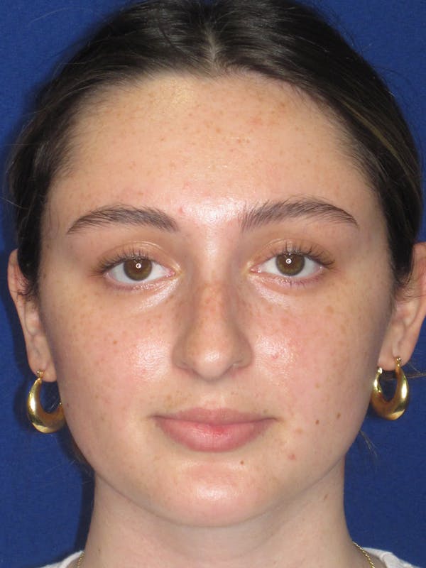 Rhinoplasty Before & After Gallery - Patient 283039 - Image 3