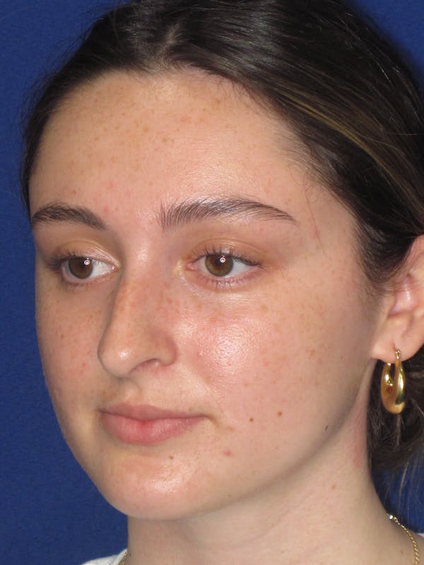 Rhinoplasty Before & After Gallery - Patient 283039 - Image 7