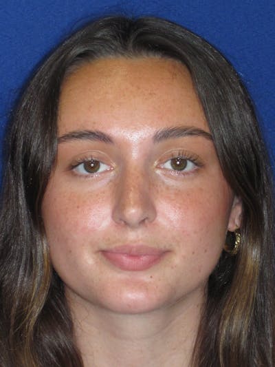 Rhinoplasty Before & After Gallery - Patient 283039 - Image 4