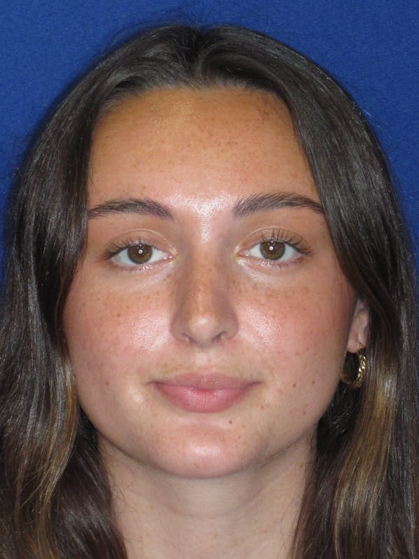 Rhinoplasty Before & After Gallery - Patient 283039 - Image 4
