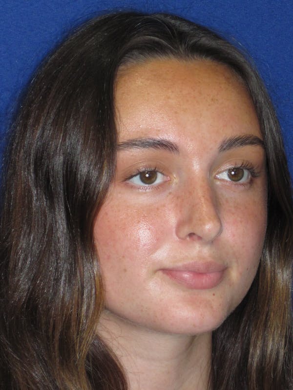 Rhinoplasty Before & After Gallery - Patient 283039 - Image 6