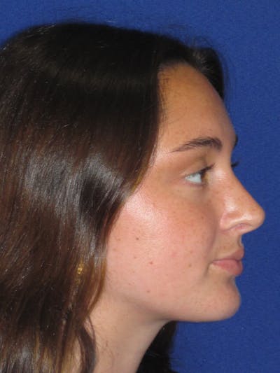 Rhinoplasty Before & After Gallery - Patient 283039 - Image 2