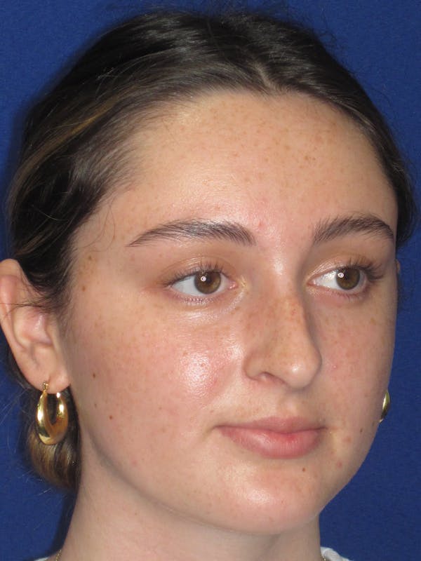 Rhinoplasty Before & After Gallery - Patient 283039 - Image 5