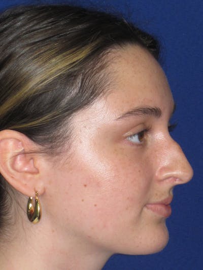 Rhinoplasty Before & After Gallery - Patient 283039 - Image 1