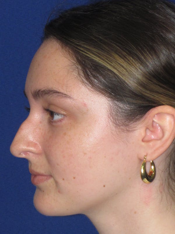 Rhinoplasty Before & After Gallery - Patient 283039 - Image 9