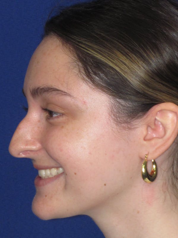 Rhinoplasty Before & After Gallery - Patient 283039 - Image 11