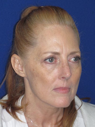 Rhinoplasty Before & After Gallery - Patient 420778 - Image 6