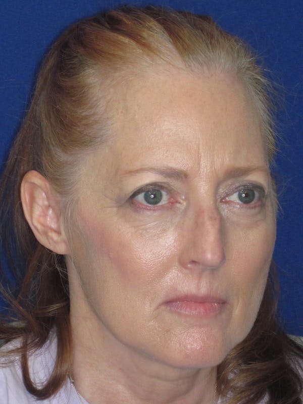 Rhinoplasty Before & After Gallery - Patient 420778 - Image 5