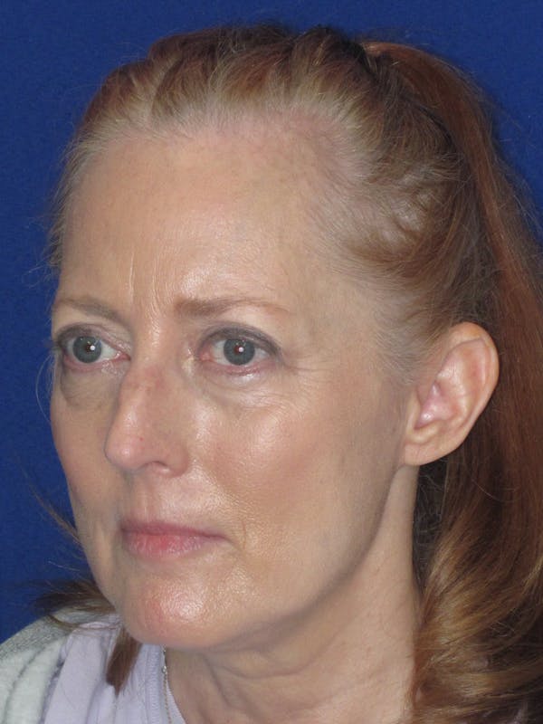 Rhinoplasty Before & After Gallery - Patient 420778 - Image 7