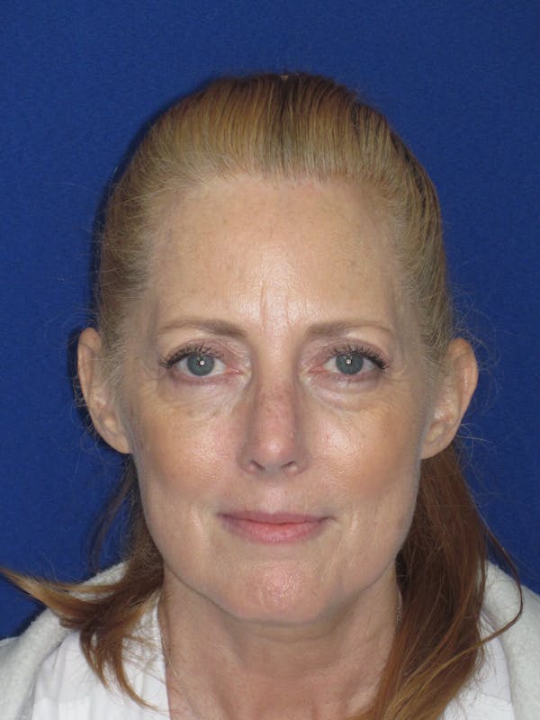 Rhinoplasty Before & After Gallery - Patient 420778 - Image 4