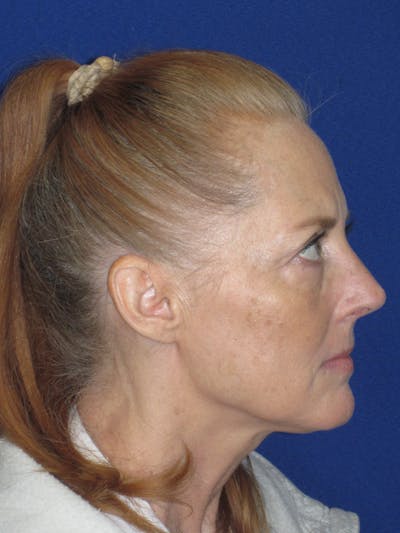 Rhinoplasty Before & After Gallery - Patient 420778 - Image 2