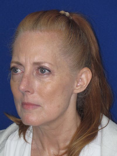 Rhinoplasty Before & After Gallery - Patient 420778 - Image 8