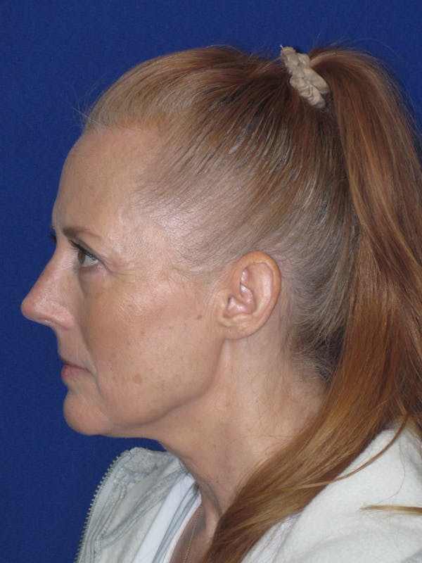 Rhinoplasty Before & After Gallery - Patient 420778 - Image 10
