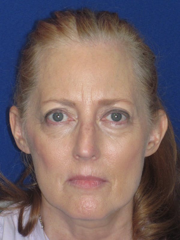 Rhinoplasty Before & After Gallery - Patient 420778 - Image 3