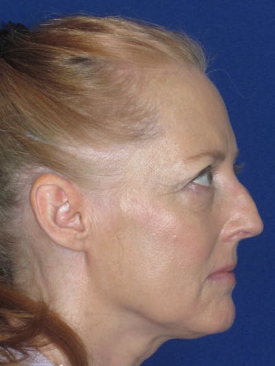 Rhinoplasty Before & After Gallery - Patient 420778 - Image 1