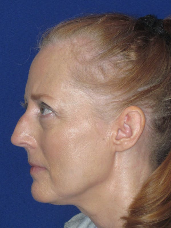 Rhinoplasty Before & After Gallery - Patient 420778 - Image 9