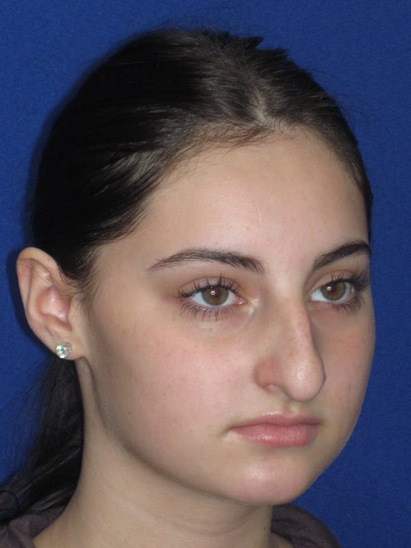Rhinoplasty Before & After Gallery - Patient 795528 - Image 3