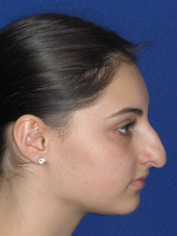 Rhinoplasty Before & After Gallery - Patient 795528 - Image 5