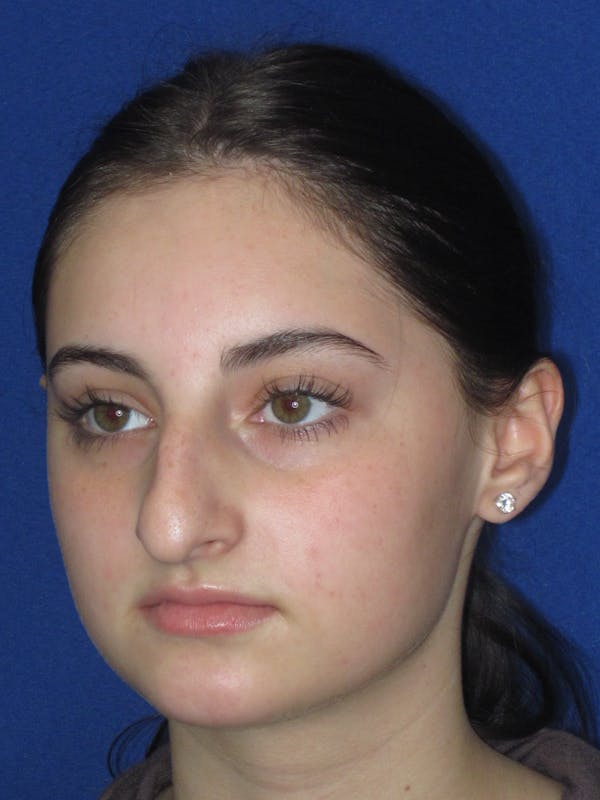 Rhinoplasty Before & After Gallery - Patient 795528 - Image 7