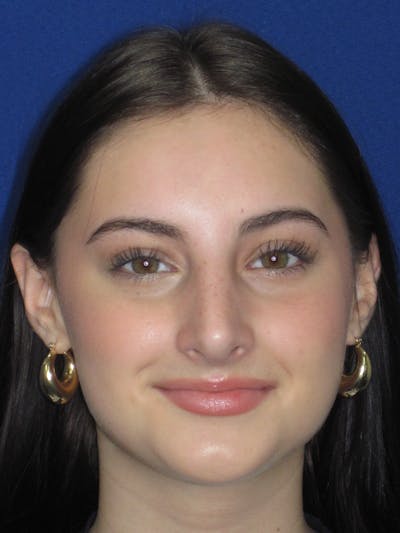 Rhinoplasty Before & After Gallery - Patient 795528 - Image 2