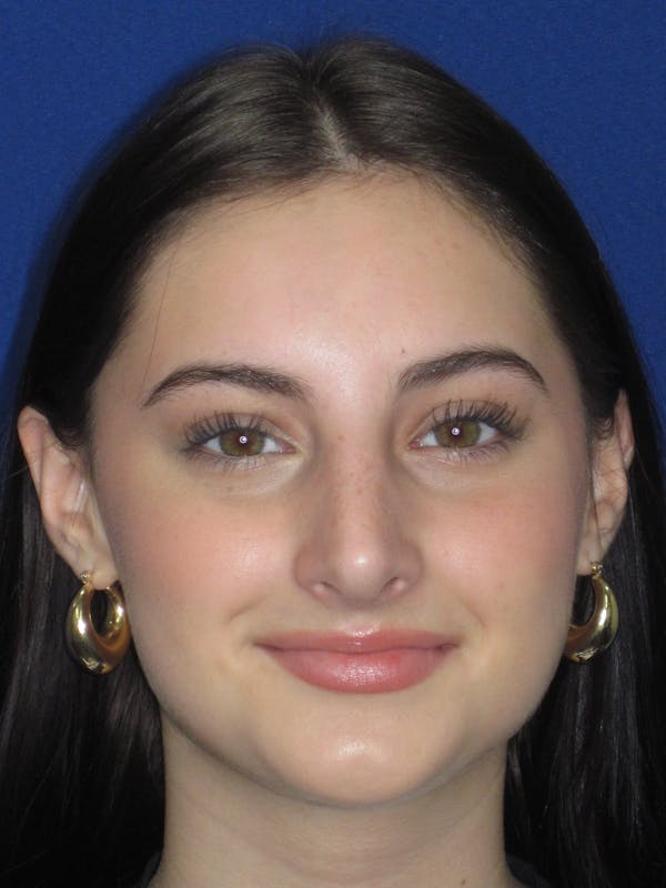 Rhinoplasty Before & After Gallery - Patient 795528 - Image 2