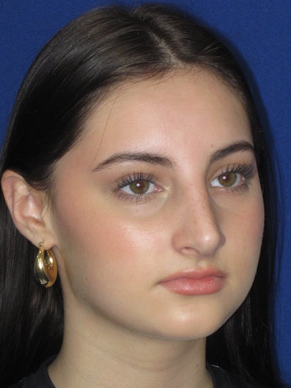 Rhinoplasty Before & After Gallery - Patient 795528 - Image 4