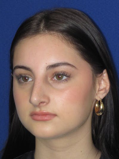 Rhinoplasty Before & After Gallery - Patient 795528 - Image 8