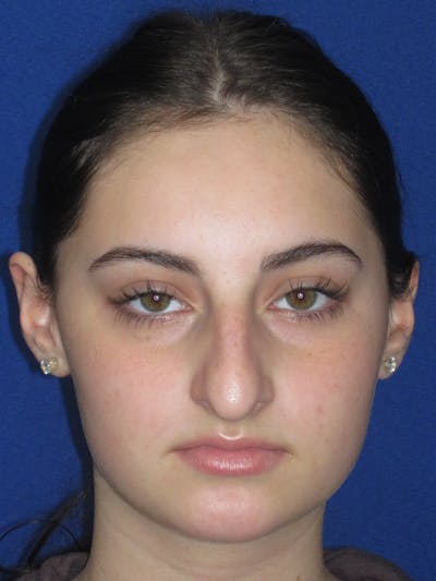 Rhinoplasty Before & After Gallery - Patient 795528 - Image 1