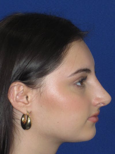 Rhinoplasty Before & After Gallery - Patient 795528 - Image 6