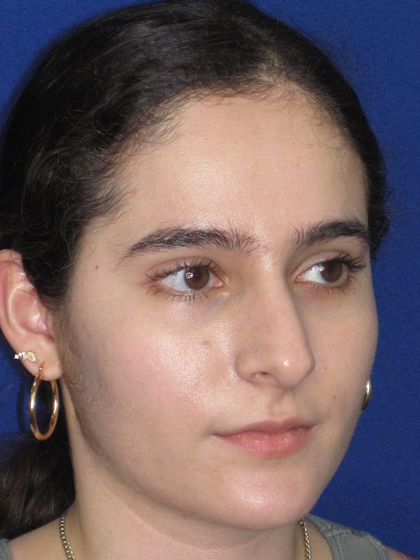 Rhinoplasty Before & After Gallery - Patient 143091 - Image 3