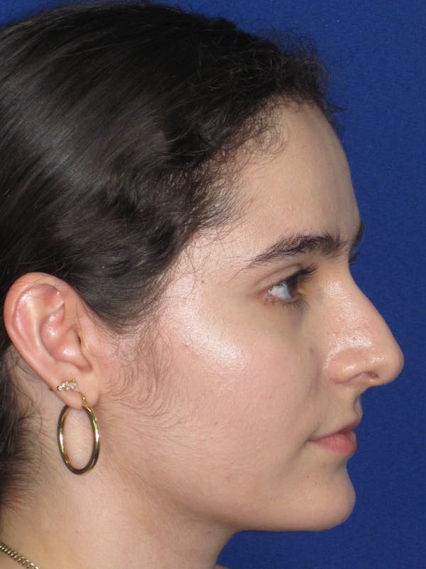 Rhinoplasty Before & After Gallery - Patient 143091 - Image 5