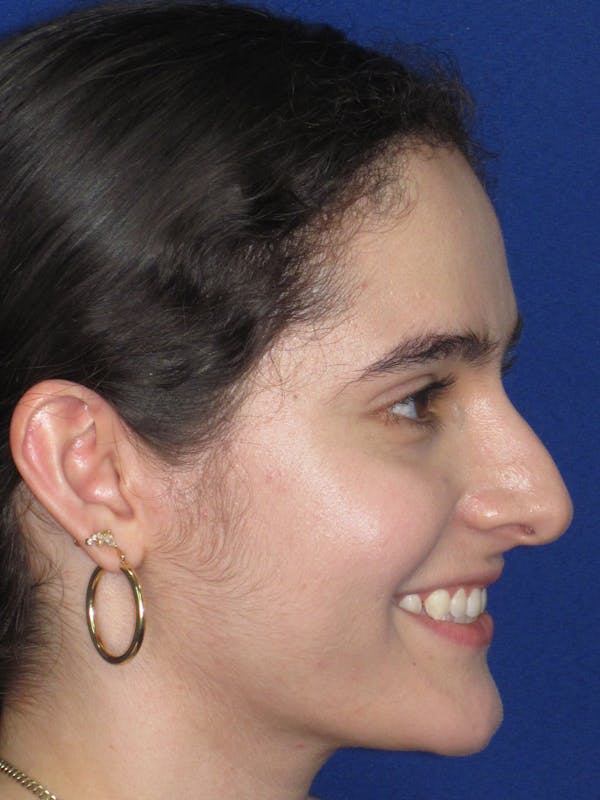 Rhinoplasty Before & After Gallery - Patient 143091 - Image 7