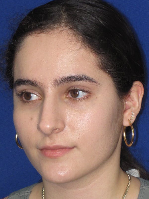 Rhinoplasty Before & After Gallery - Patient 143091 - Image 9