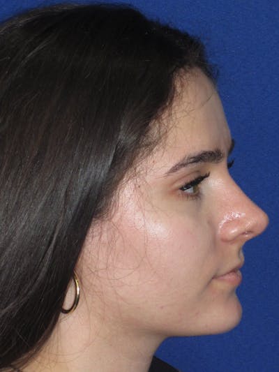Rhinoplasty Before & After Gallery - Patient 143091 - Image 6