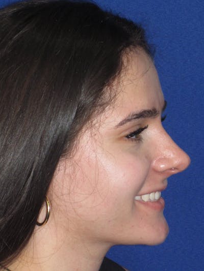 Rhinoplasty Before & After Gallery - Patient 143091 - Image 8