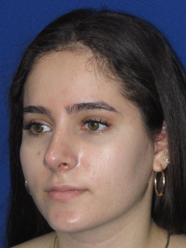 Rhinoplasty Before & After Gallery - Patient 143091 - Image 10