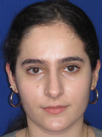 Rhinoplasty Before & After Gallery - Patient 143091 - Image 1