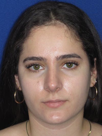 Rhinoplasty Before & After Gallery - Patient 143091 - Image 2