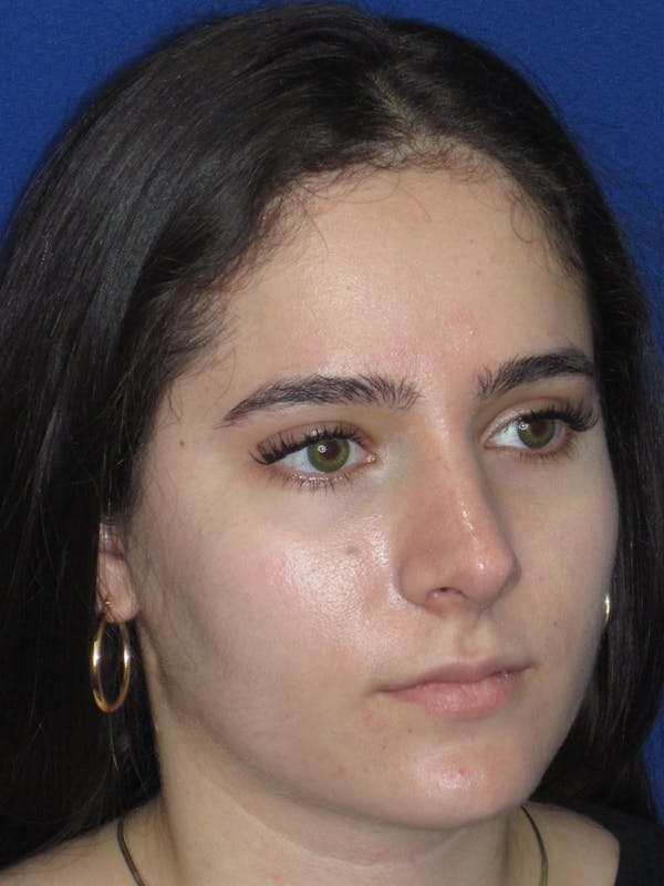 Rhinoplasty Before & After Gallery - Patient 143091 - Image 4