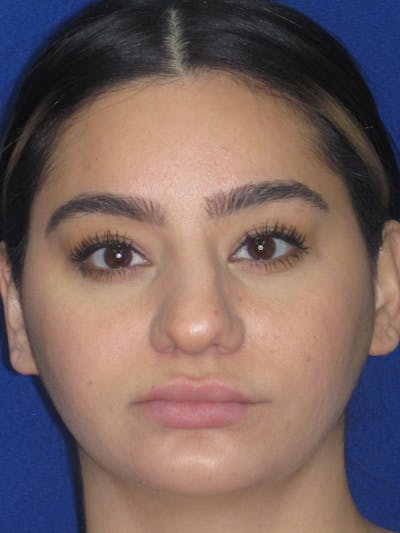 Rhinoplasty Before & After Gallery - Patient 367952 - Image 1