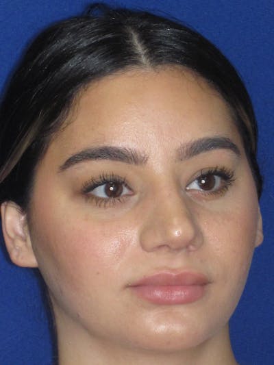 Rhinoplasty Before & After Gallery - Patient 367952 - Image 4