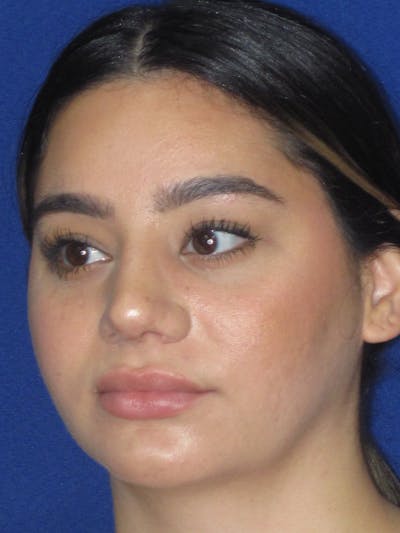 Rhinoplasty Before & After Gallery - Patient 367952 - Image 8