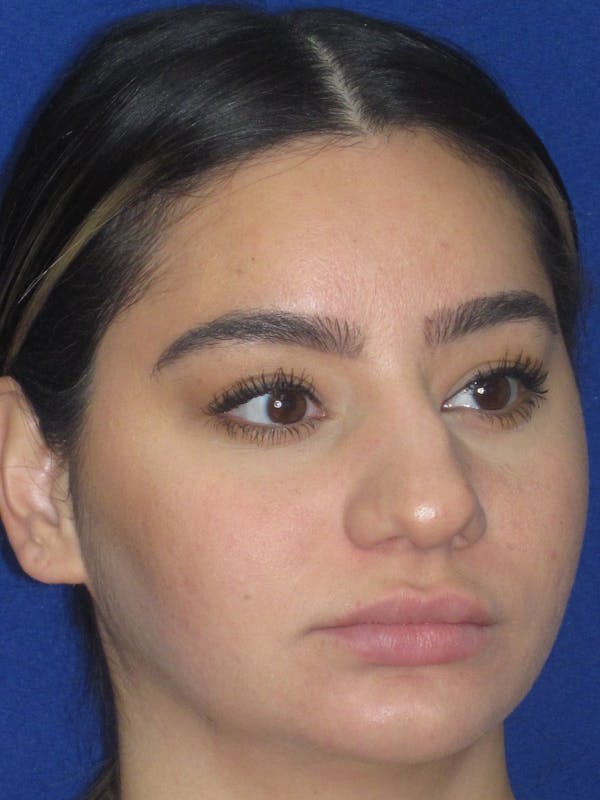Rhinoplasty Before & After Gallery - Patient 367952 - Image 3
