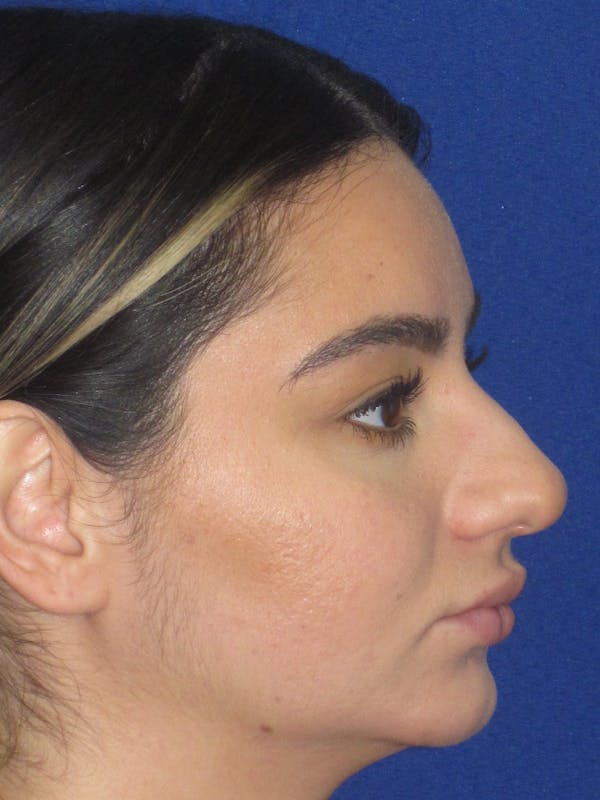 Rhinoplasty Before & After Gallery - Patient 367952 - Image 5